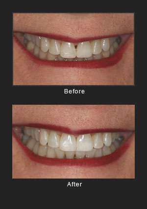 Cosmetic bonding before and after