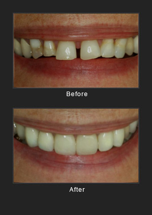 Dental implants before and after