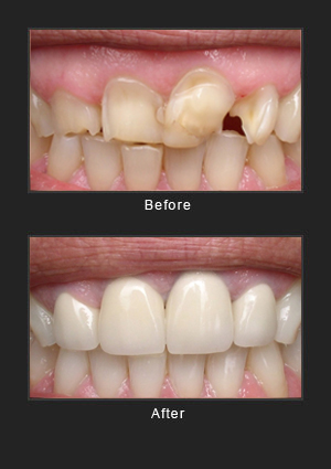 Porcelain veneers before and after